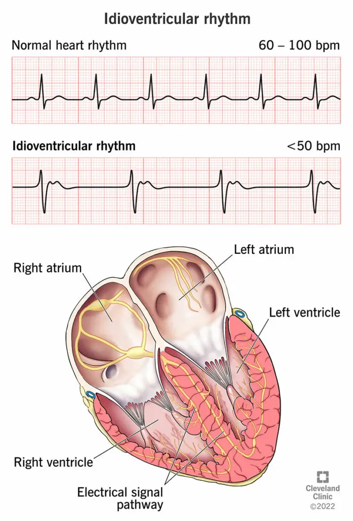 1708256113 23070 idioventricular rhythm