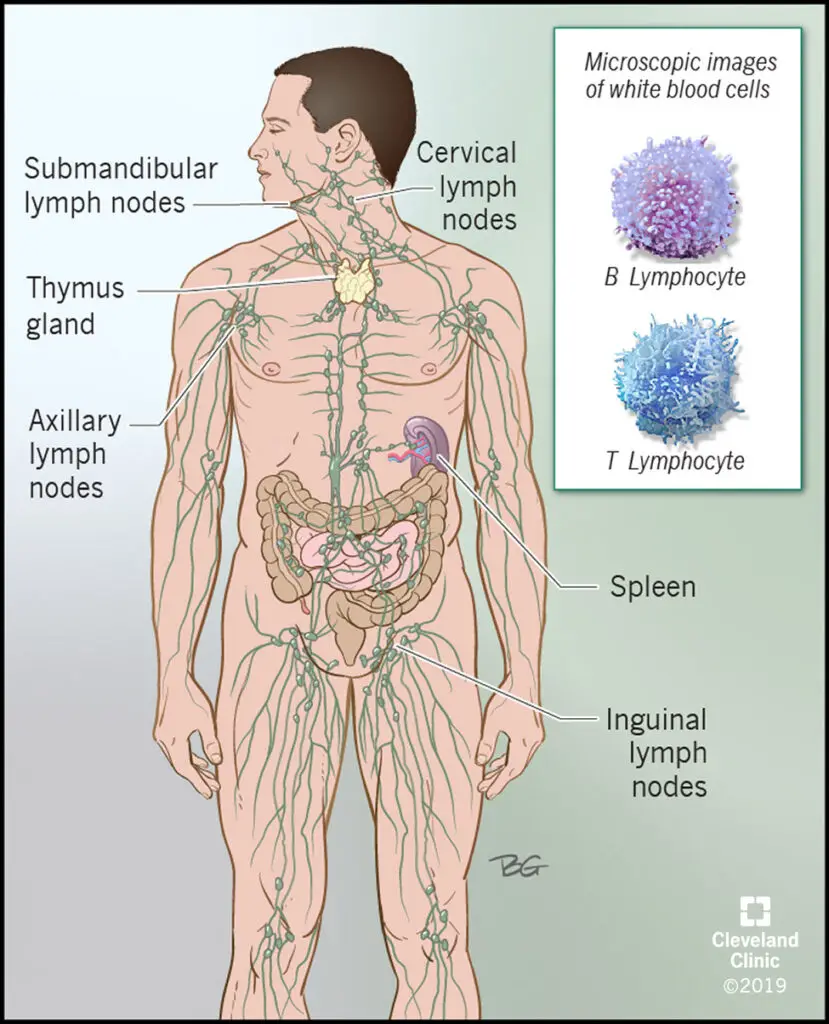 1708260675 17920 castleman disease