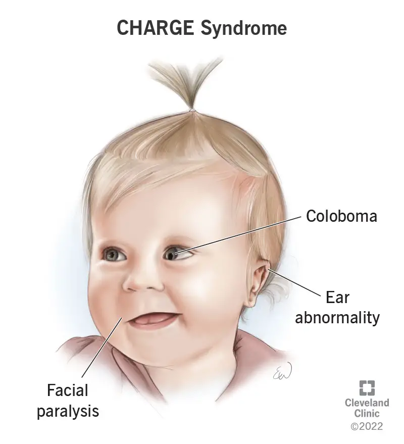 1708274355 23472 CHARGE syndrome