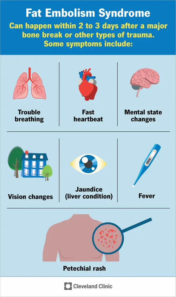 1708447879 23995 fat embolism syndrome