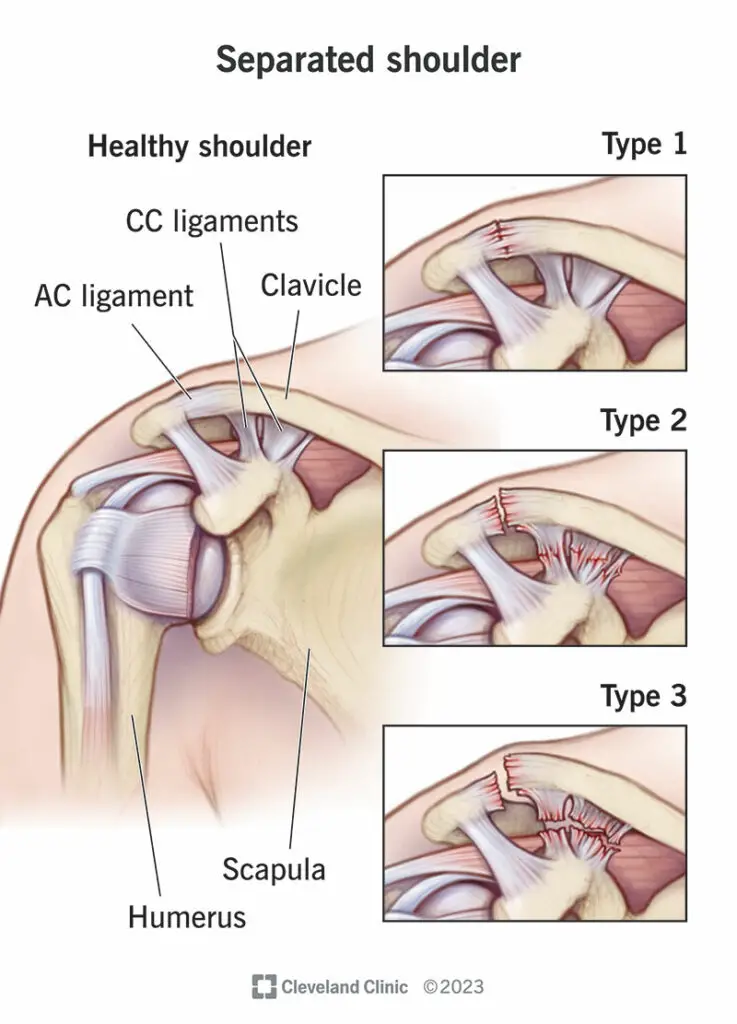 1708456997 separated shoulder