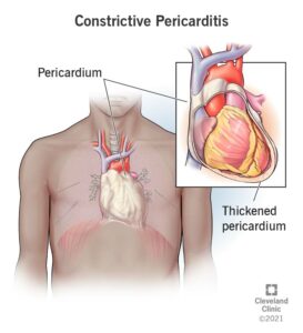 1708520899 22373 constructive pericarditis