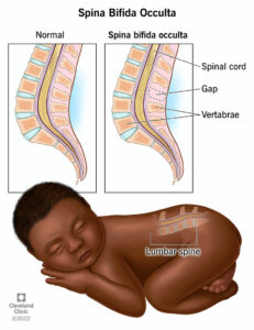 1708539138 22825 spina bifida occulta