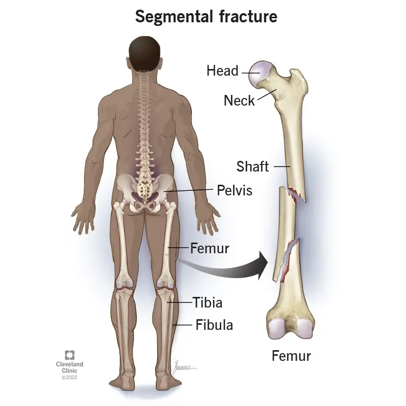 1708571060 22234 segmental fracture