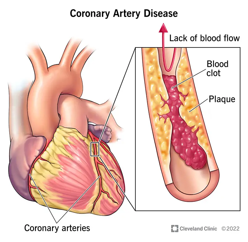 1708589374 16898 coronary artery disease