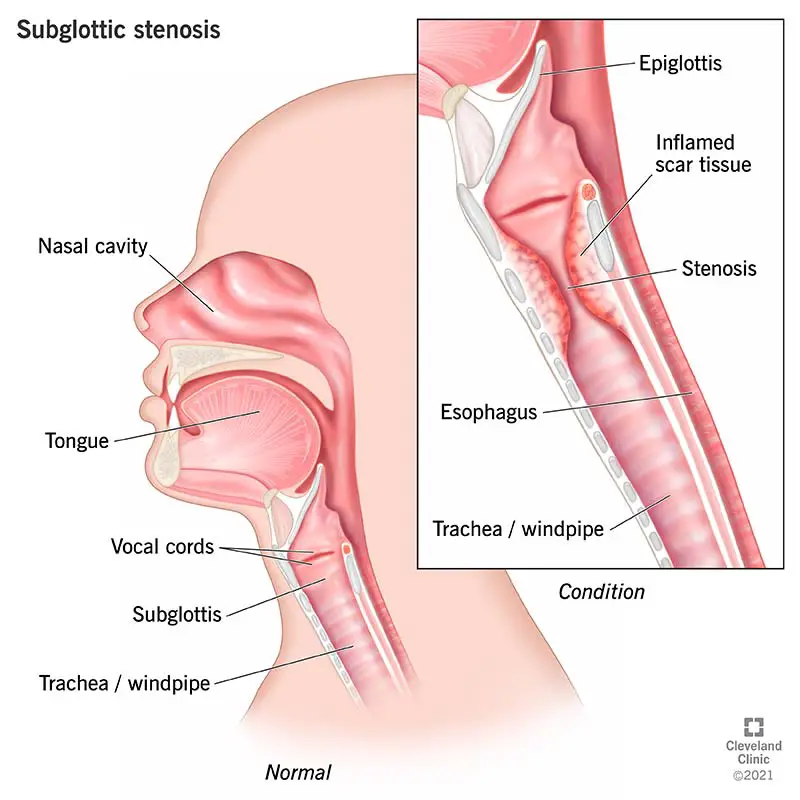 1708607666 22031 subglottic stenosis illustration