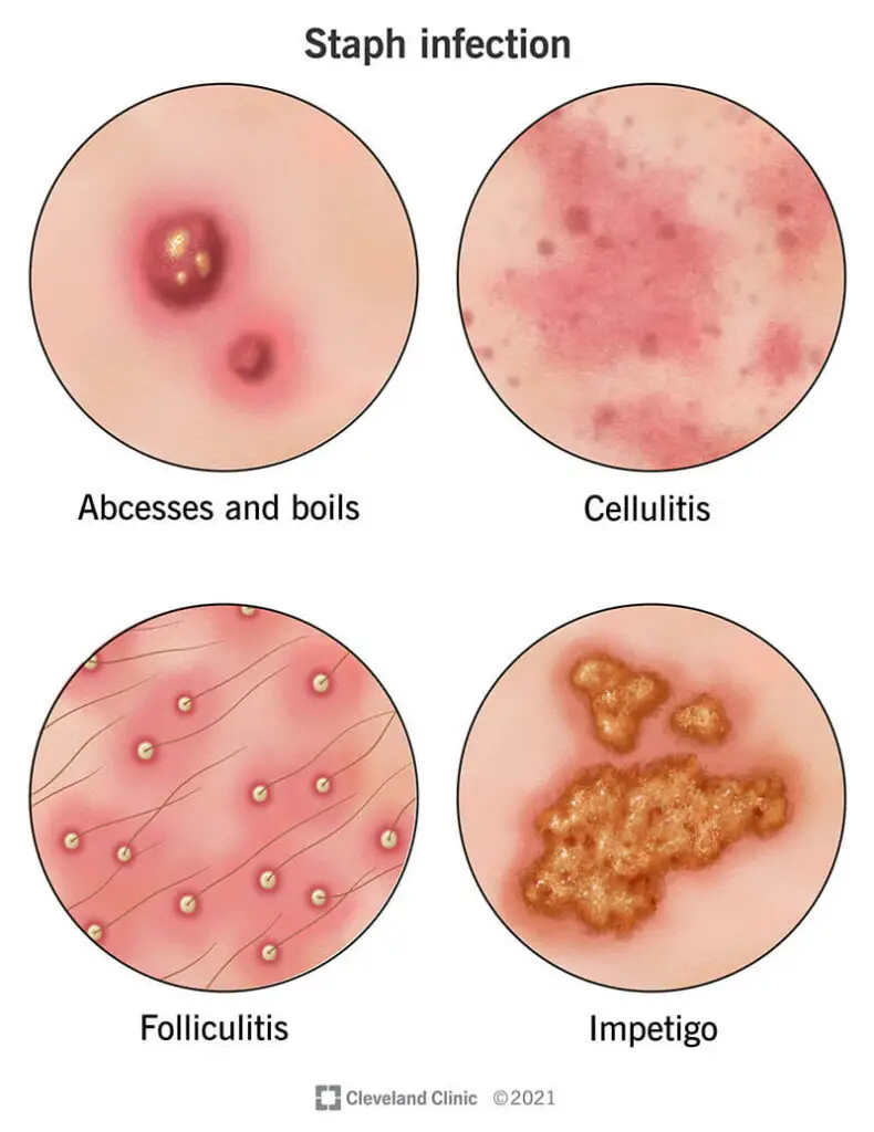 1708612284 21165 staph infection