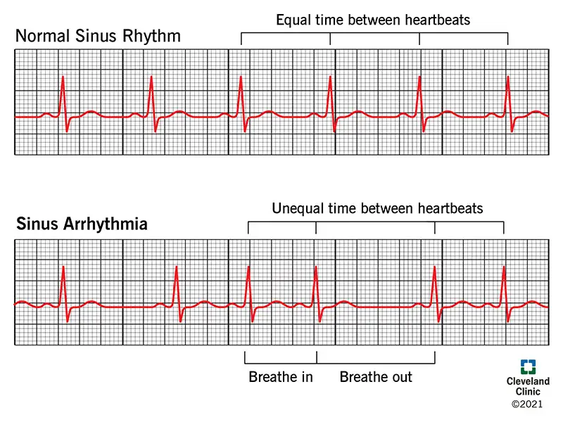 1708621406 21666 sinus arrhythmia illustration