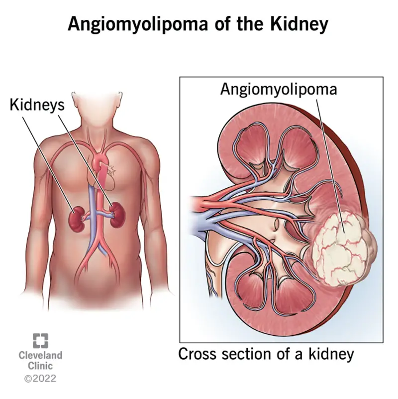 1708662557 22415 angiomyolipoma kidney