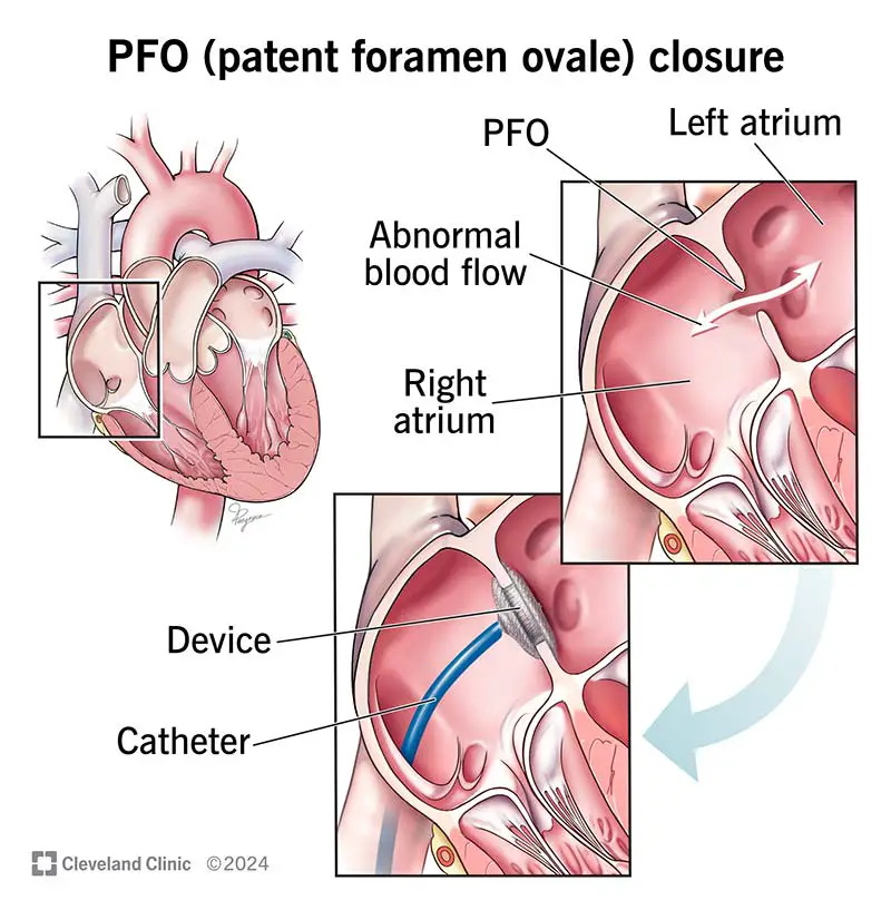 1708674264 17326 patent foramen ovale