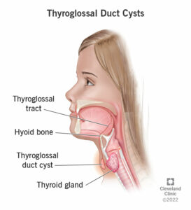 1708689983 22351 thyroglossal duct cysts