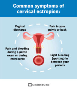 1708708279 23053 cervical ectropion