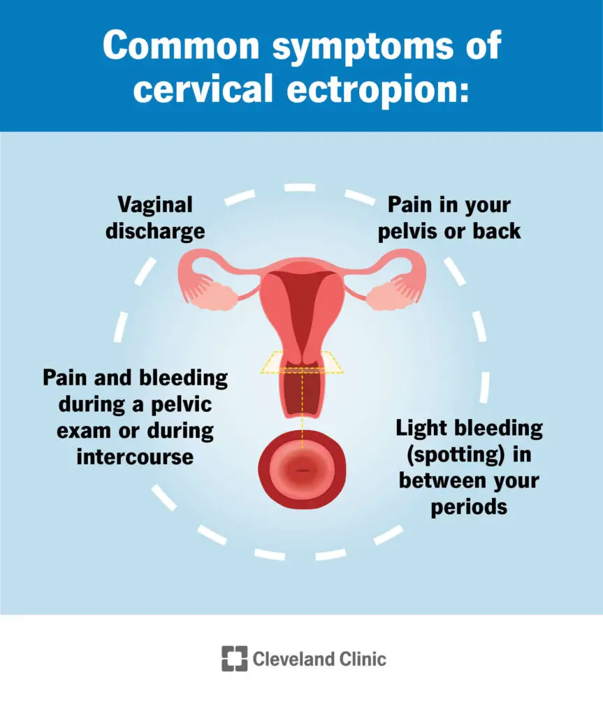 1708708279 23053 cervical ectropion