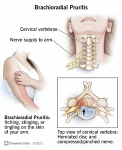 1708740198 21181 brachioradial pruritis