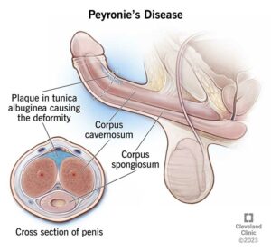 1708767682 10044 peyronies disease