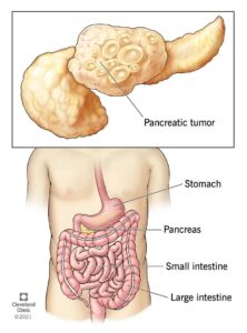 1708785919 21786 pancreatic cancer illustration