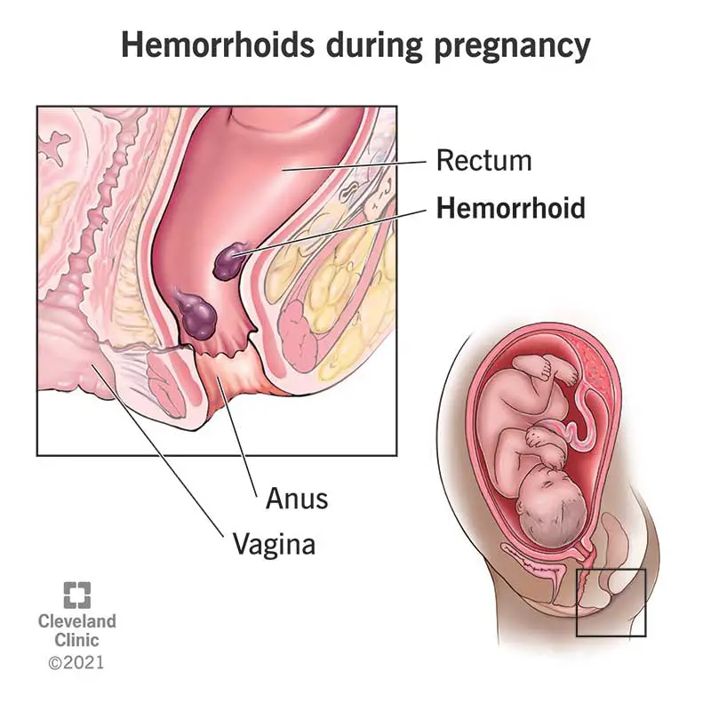 1708877359 23498 pregnancy hemorrhoids