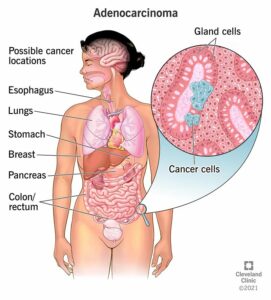 1709047103 21652 adenocarcinoma