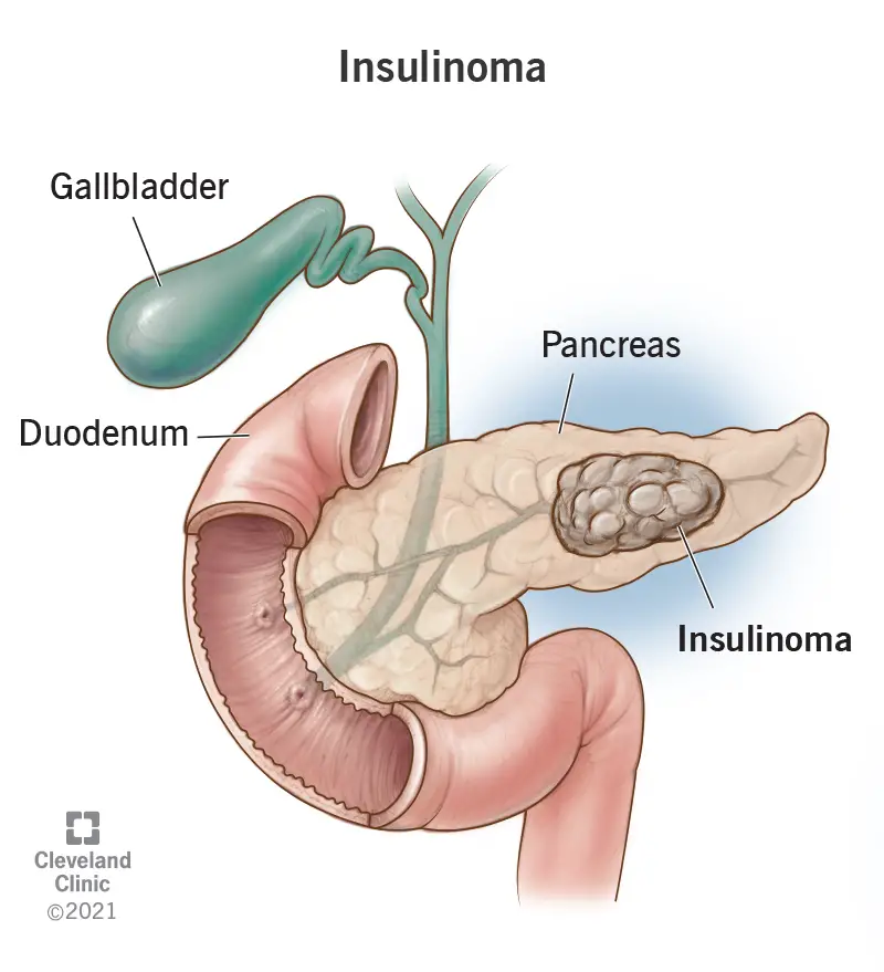 1709060780 22217 insulinoma