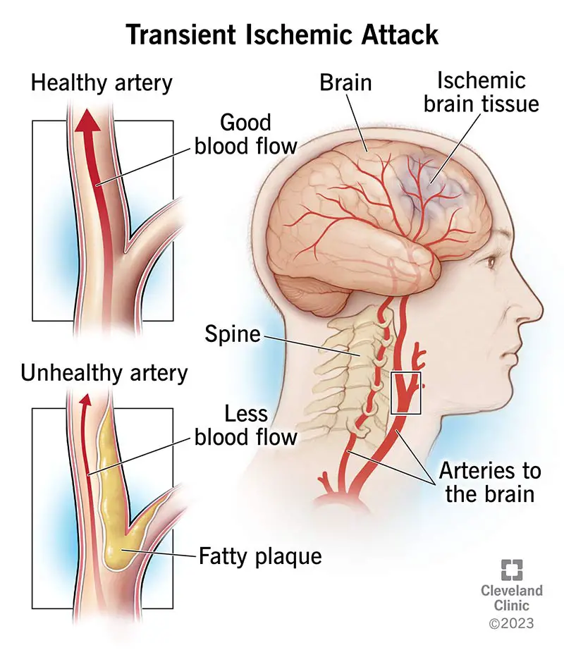 1709079023 14173 transient ischemic attack