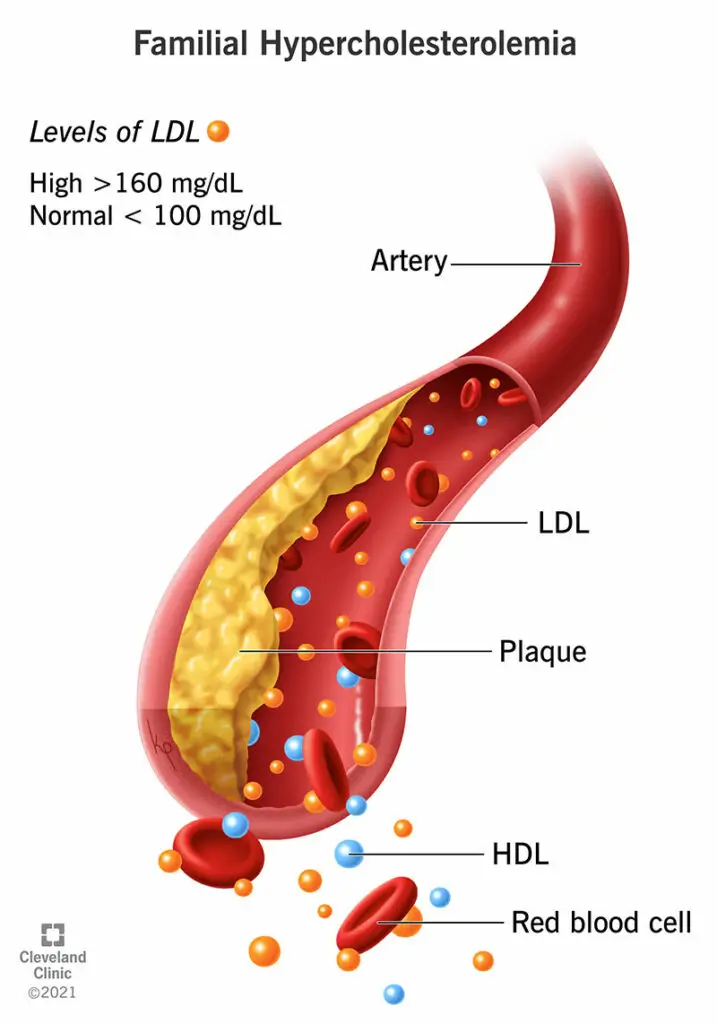 1709111061 22067 familial hypercholesterolemia illustration