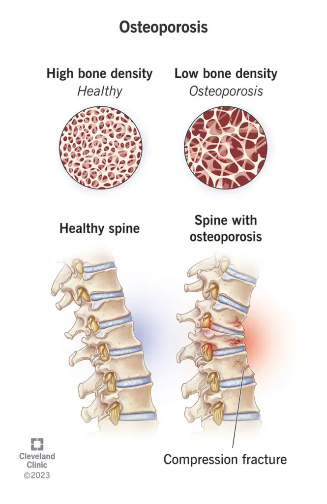 1709138421 4443 osteoporosis