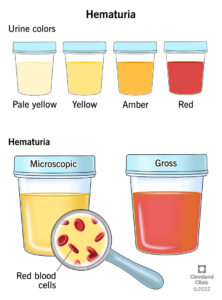 1709161218 15234 hematuria illustration