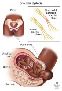 1709179459 22311 shoulder dystocia