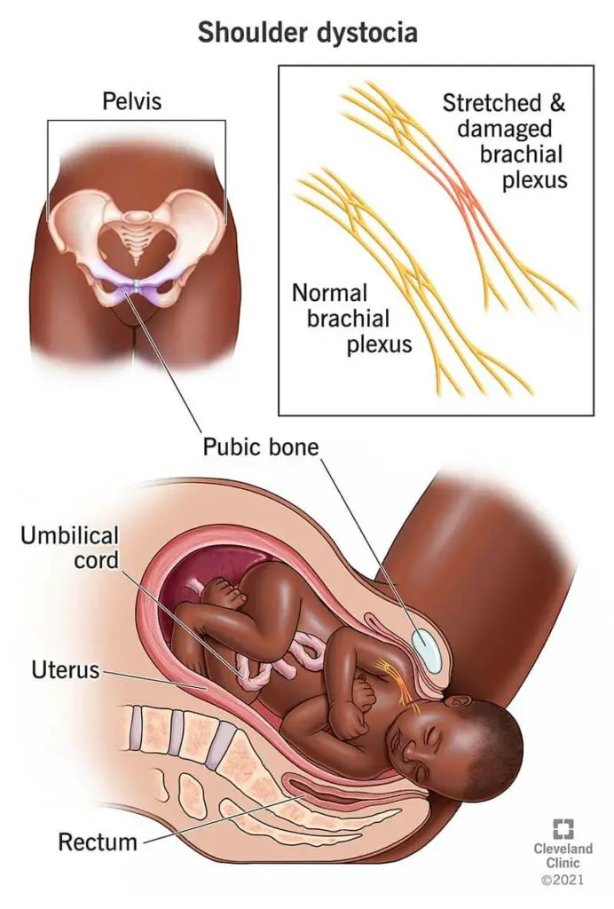 1709179459 22311 shoulder dystocia