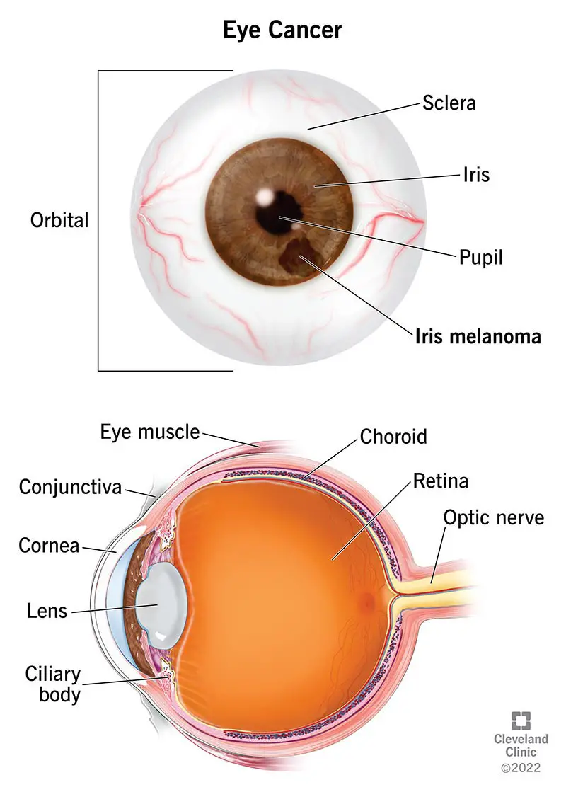 Priekšējais un sānu skats uz acs ābola ar varavīksnenes melanomu anatomiju.