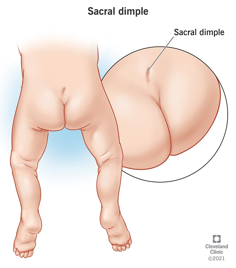 17780 sacral dimple