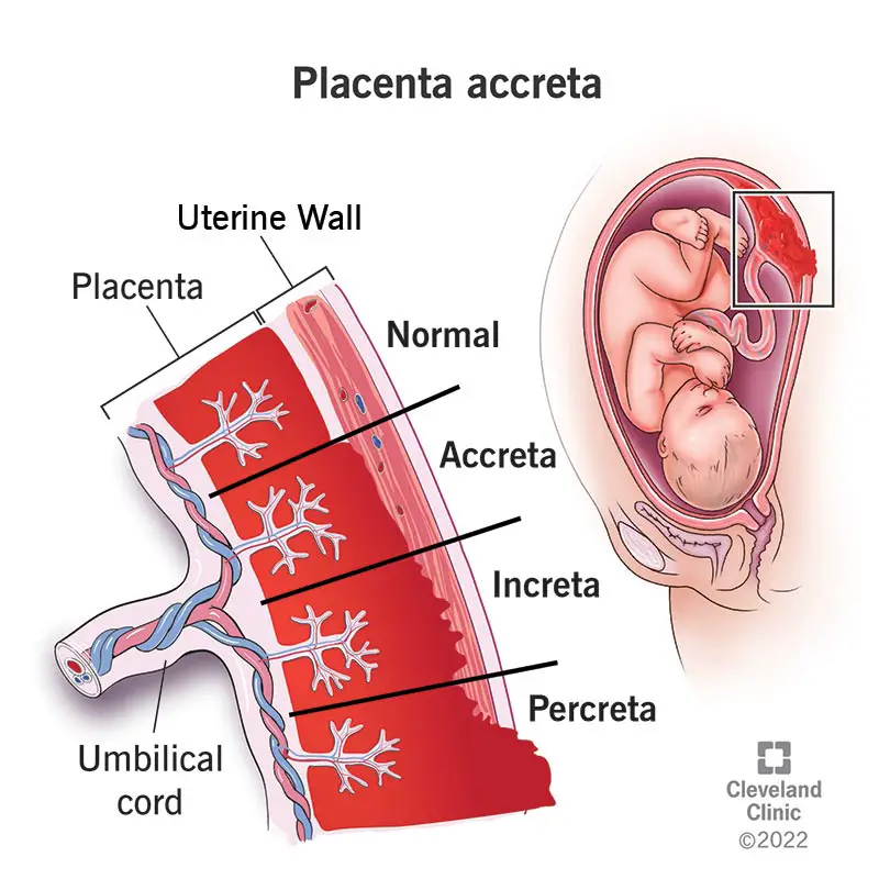 Ilustrācija ar placentas iegulšanu dzemdes sienā, kad personai ir placenta accreta, increta vai percreta.