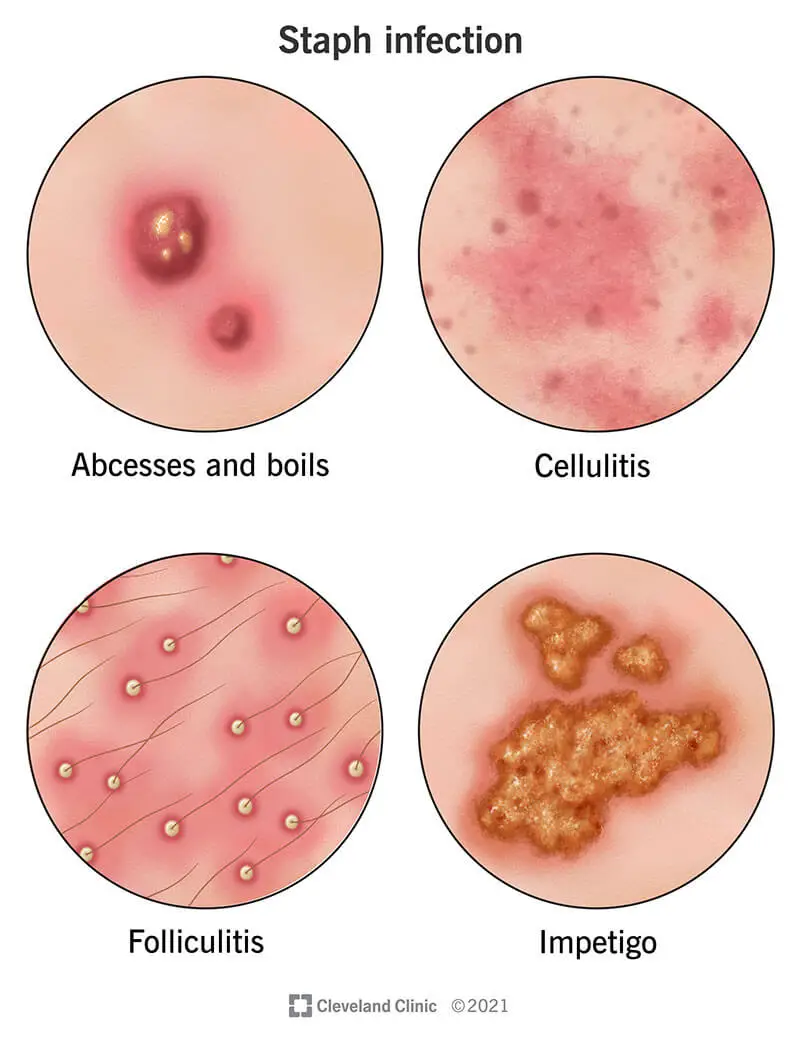 Stafilokoku infekcija uz ādas var izpausties kā mazi strutas pilni kunkuļi ar folikulītu, lielāki kunkuļi ar abscesiem un augoņiem un neregulāri kreveles ar impetigo, savukārt celulīts ādā izpaužas kā iekaisuši plankumi.