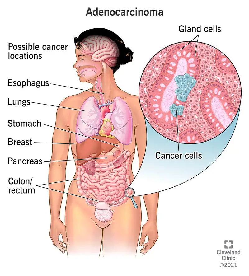 cilvēka ķermenī ir adenokarcinomas vēzis
