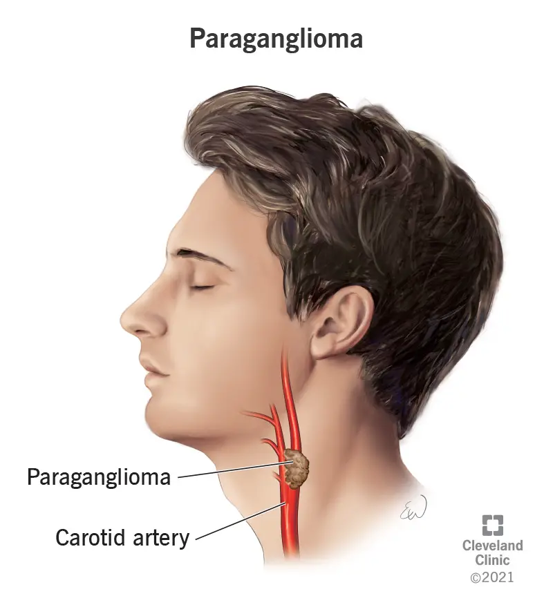 Galvas un kakla paraganglioma