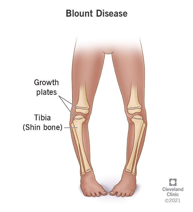 22424 blounts disease