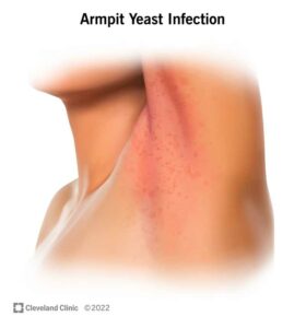 22908 armpit yeast infection