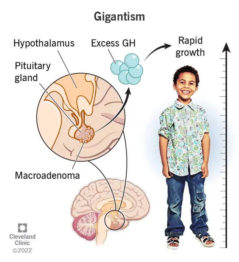 Gigantisms rodas, ja audzējs uz hipofīzes ražo augstu augšanas hormona līmeni, kā rezultātā bērns izaug ļoti garš.