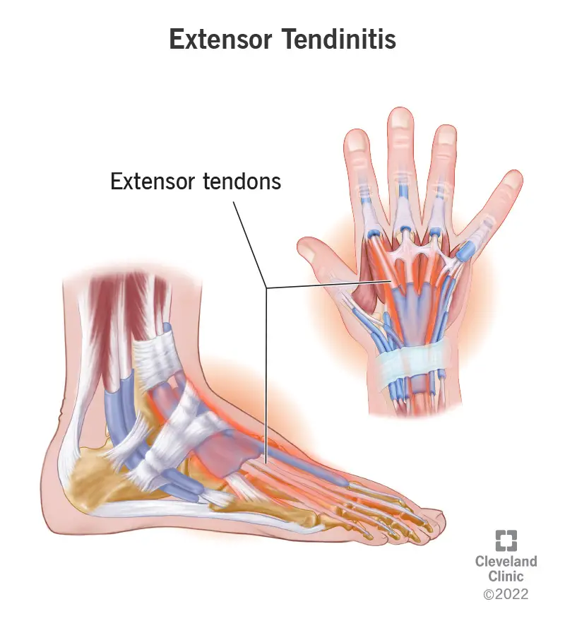 Extensor tendinīts iezīmēts uz rokas un pēdas.