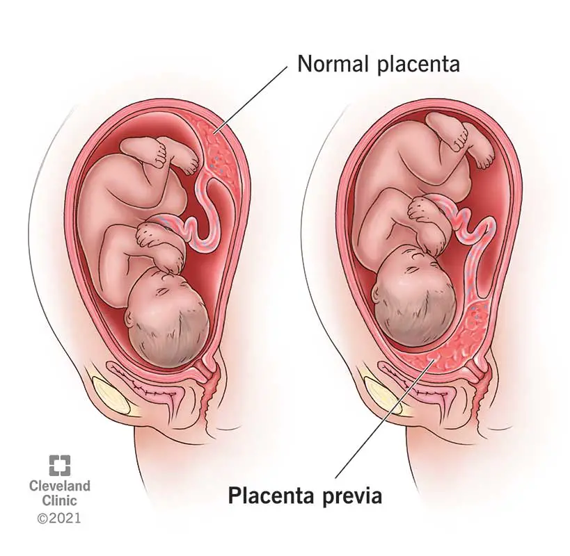 Placenta, kas aptver dzemdes kaklu.