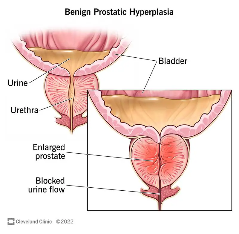 Labdabīga prostatas hiperplāzija izraisa prostatas palielināšanos.  Tas var izspiest urīnizvadkanālu un bloķēt urīna plūsmu