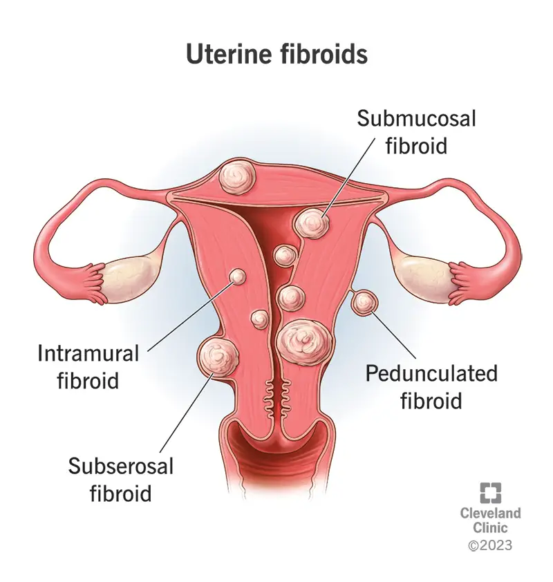 Dzemde, kurā parādīti četri fibroīdu veidi un kur tie var attīstīties.