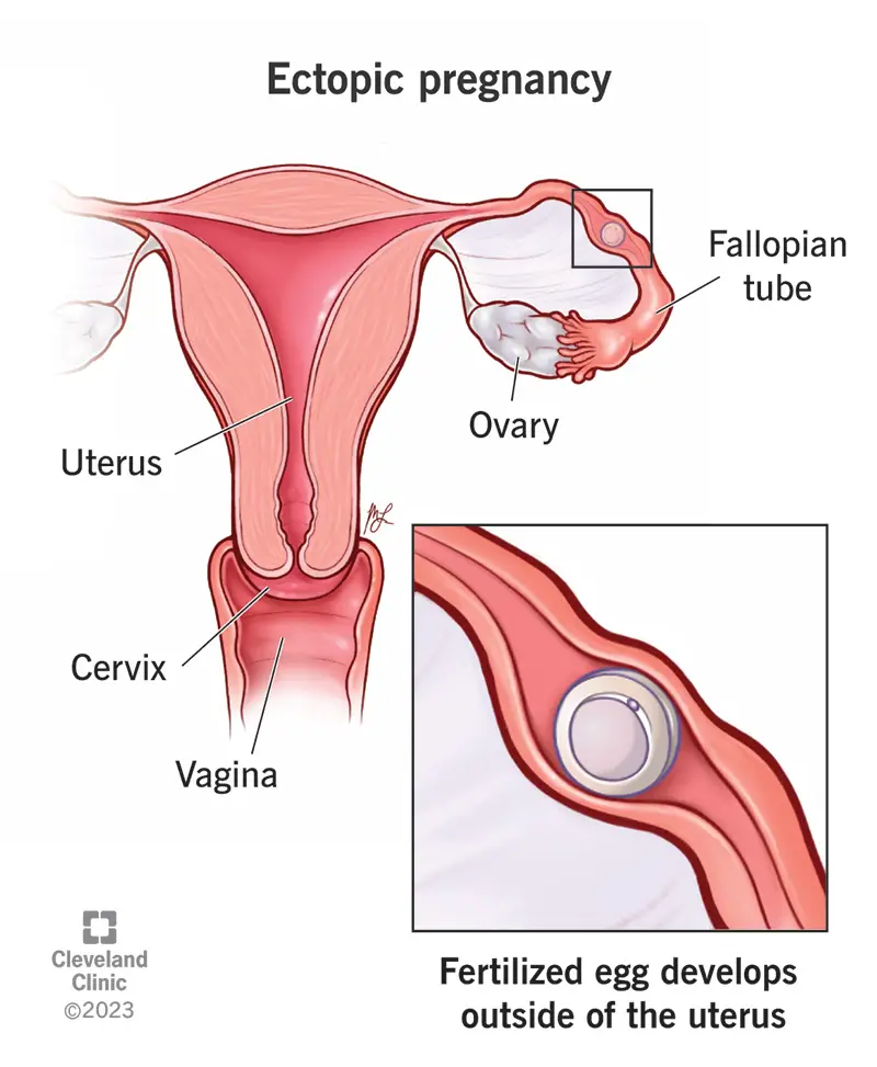 Apaugļota olšūna, kas implantējas olvados.