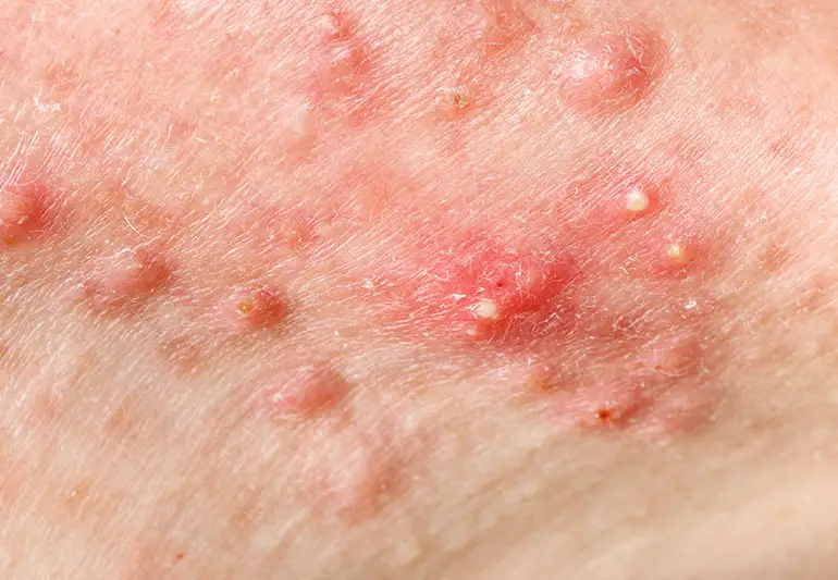 CysticAcne 694069050 770x533 1