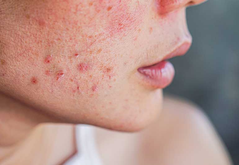 Hormonal Acne Period 1270415883 770x533 1