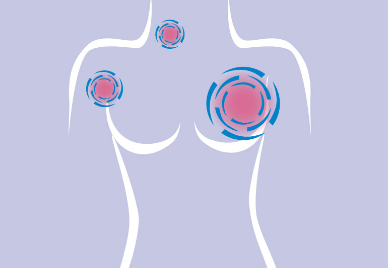 breastCancerSpread2 1256464519 770x533 1