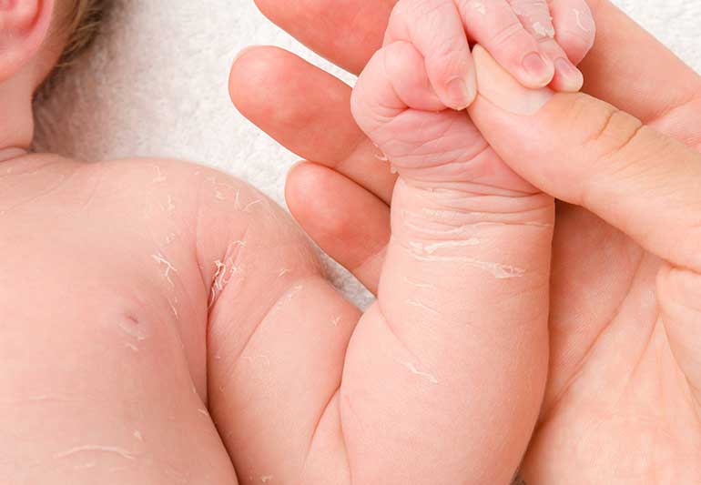 newborn skin peeling 1165471859 770x533 1