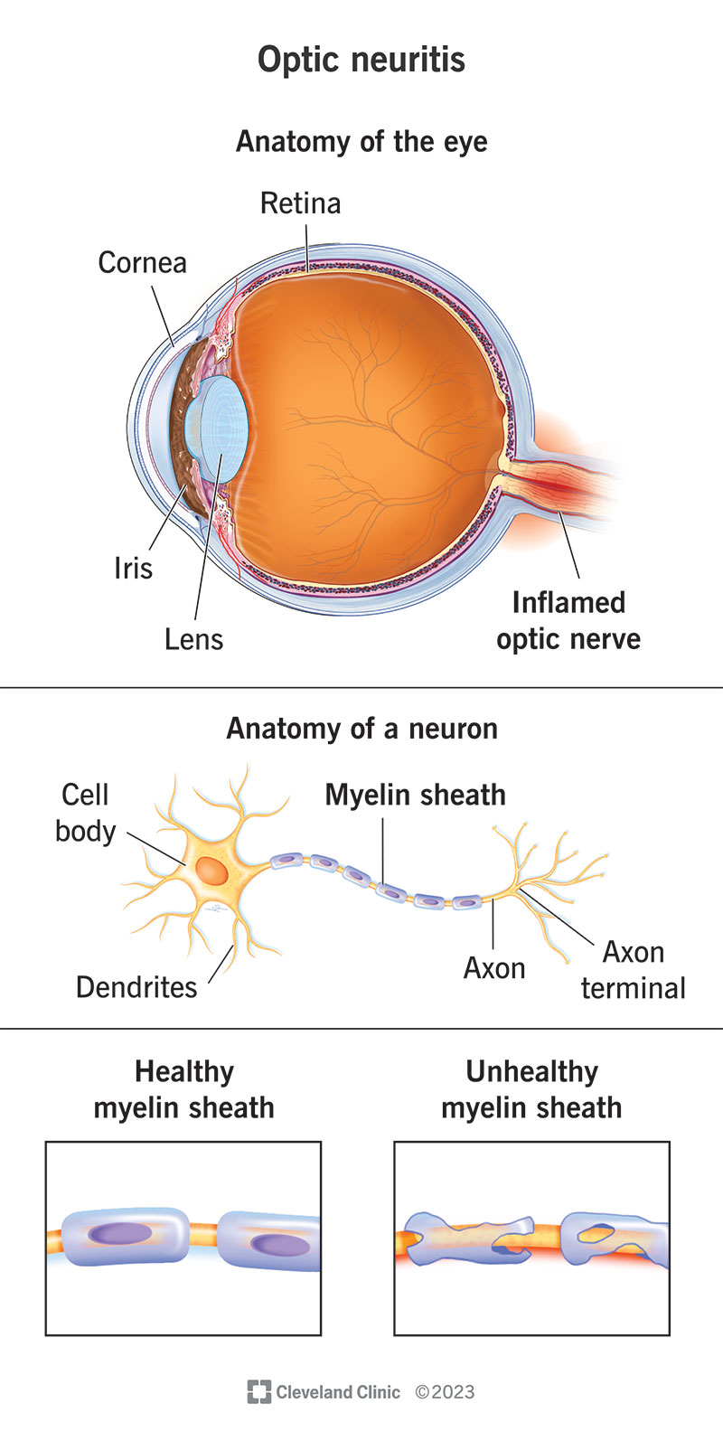 Optiskais neirīts, acs anatomija, neirona anatomija, veselīgs un neveselīgs mielīna apvalks