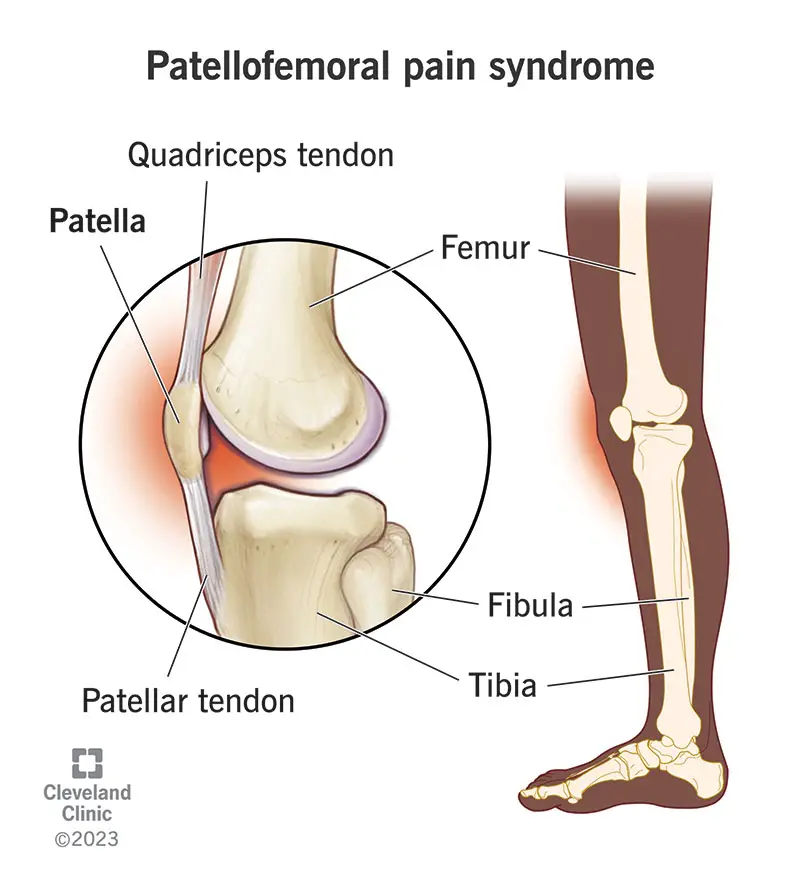 Patellofemoral sāpju sindroms izraisa ceļgala sāpes zem vai ap jūsu ceļa kauliņu (patella).