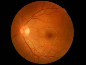 14208 macular hole